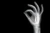 Xray of a hand