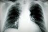 How to save millions on COPD care