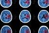 Stroke brain X-ray