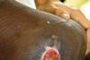 Ulcer on pigmented skin