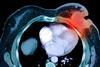 Almost 1,000 deaths from advanced breast cancer would be prevented each year if England's survival rates matched those in Norway and Sweden, research has shown.