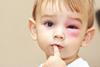 Child with swollen pink eye