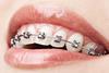 Teeth with dental braces