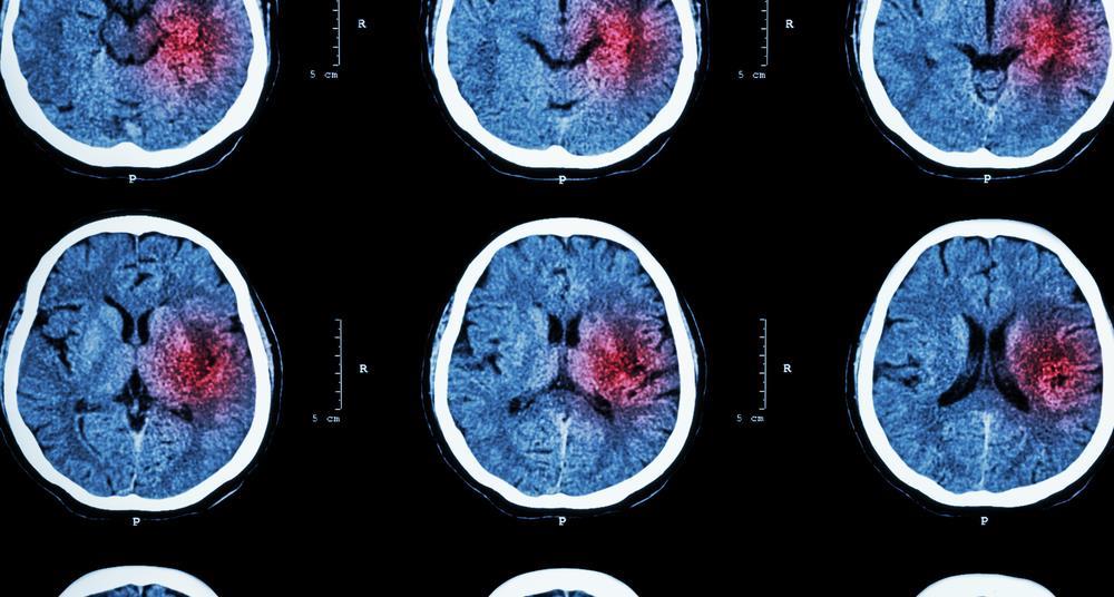 Dozens of stroke units lose ‘A’ ratings