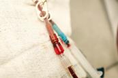 Close-up of cannulas attached to a patient's arm during kidney dialysis.