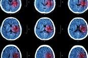 Stroke brain X-ray
