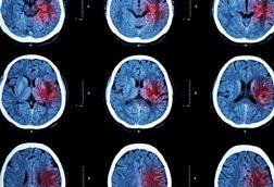 Stroke brain X-ray