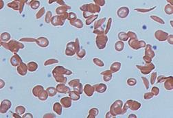 Sickle cells