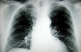 How to save millions on COPD care