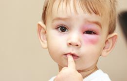 Child with swollen pink eye