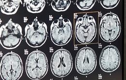 Trusts fail to keep up pace on stroke targets
