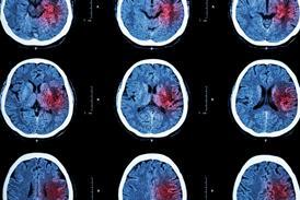 Stroke brain X-ray