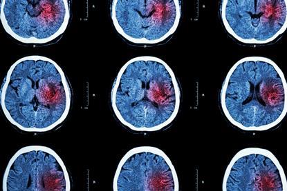 Stroke brain X-ray