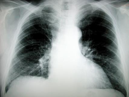 xray chest radiology