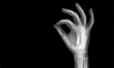 Xray of a hand