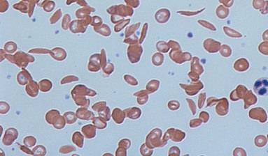 Sickle cells