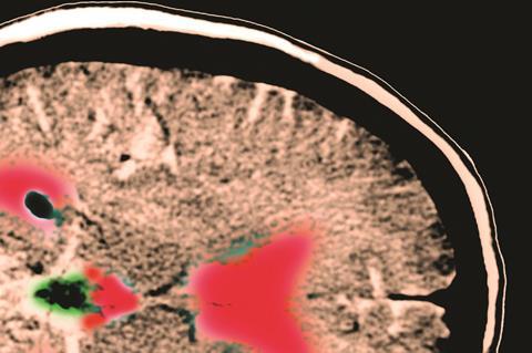 CT Brain scan