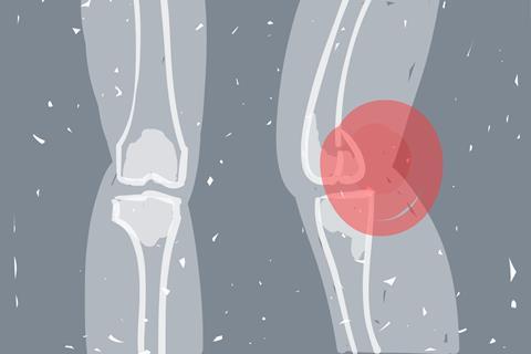 knee replacements