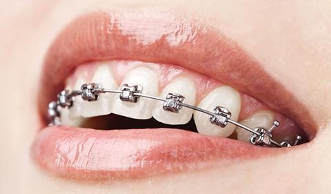 Teeth with dental braces