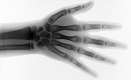 hand x ray radiotherapy
