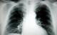 How to save millions on COPD care