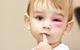 Child with swollen pink eye
